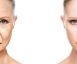 Beauty Skin Cologne - (AUF-)REIZEND SCHÖN - Mikroneedling Behandlung Thumbnail