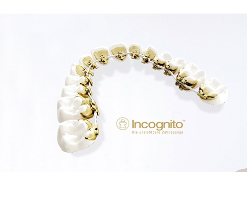 Incognito -  Lingualtechnik -Die unsichtbare Zahnspange
