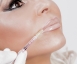 Stylage & Teosyal - Lippen aufspritzen & Faltenunterspritzung mit Hyaluronsäure  Thumbnail