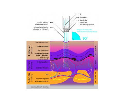 JetPeel Medical - HAUTVERJÜNGUNG JetPeel