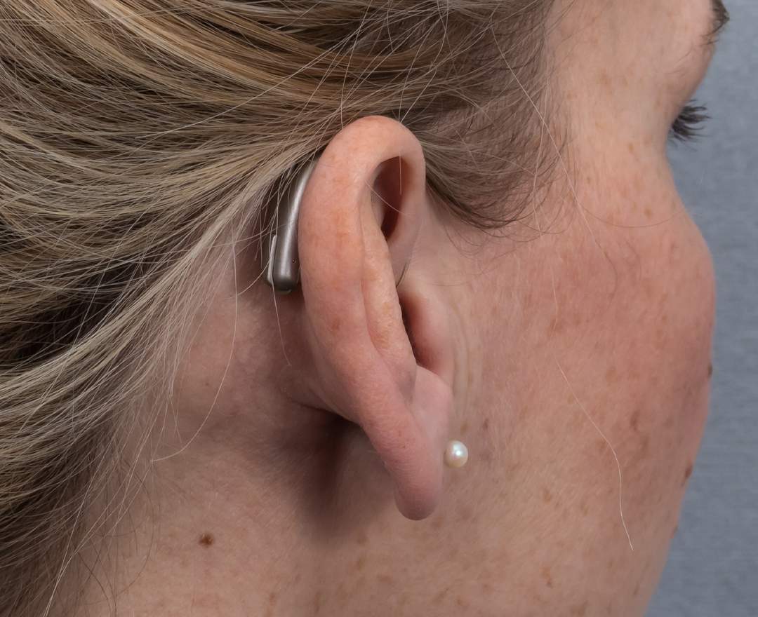 VITT HÖRAKUSTIK Hörsystem mit externem Lautsprecher (RiC) VITT HÖRAKUSTIK Hörsystem mit externem Lautsprecher (RiC)