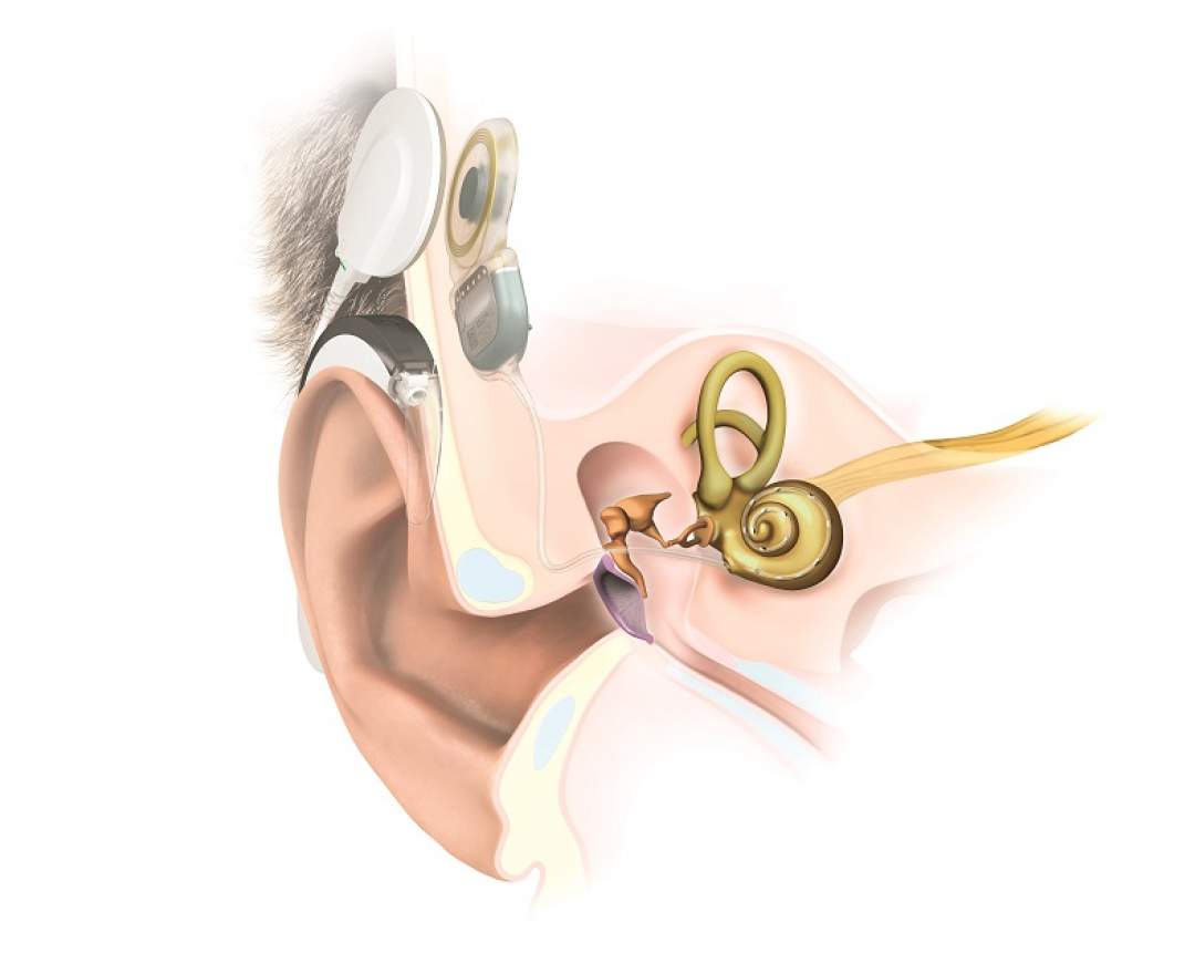 Individuell - Hörimplantate
