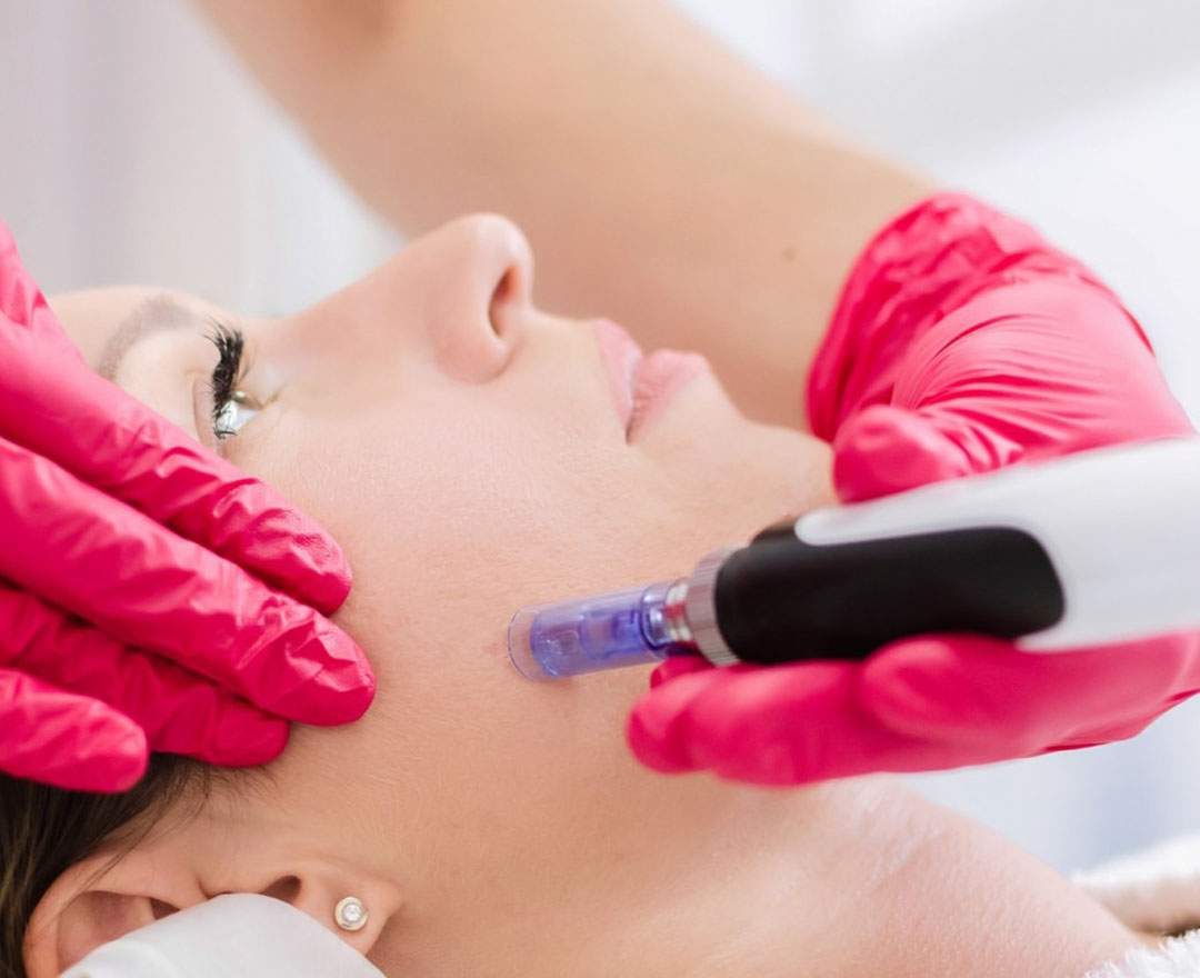 Kosmetiksalon - Kunst der Schönheit Spezial Microneedling Behandlung