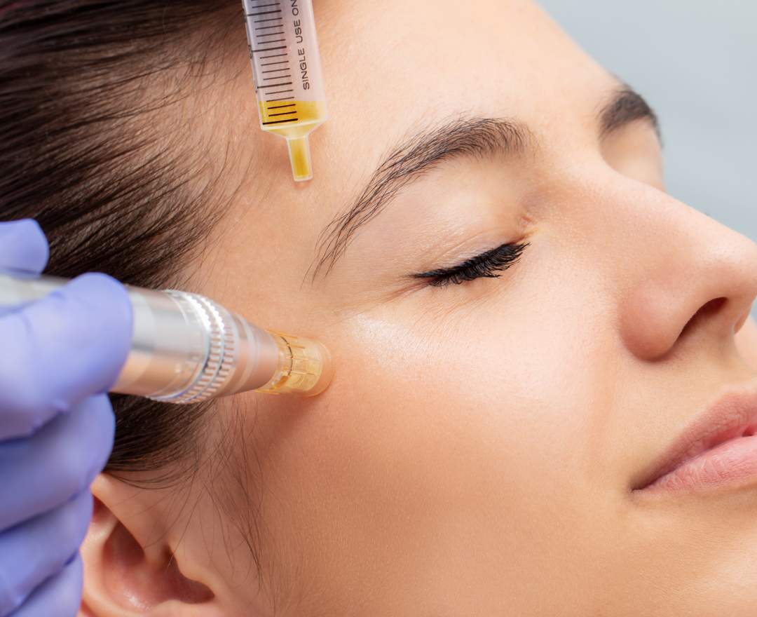 Die Hautverbesserer Micro-Needling