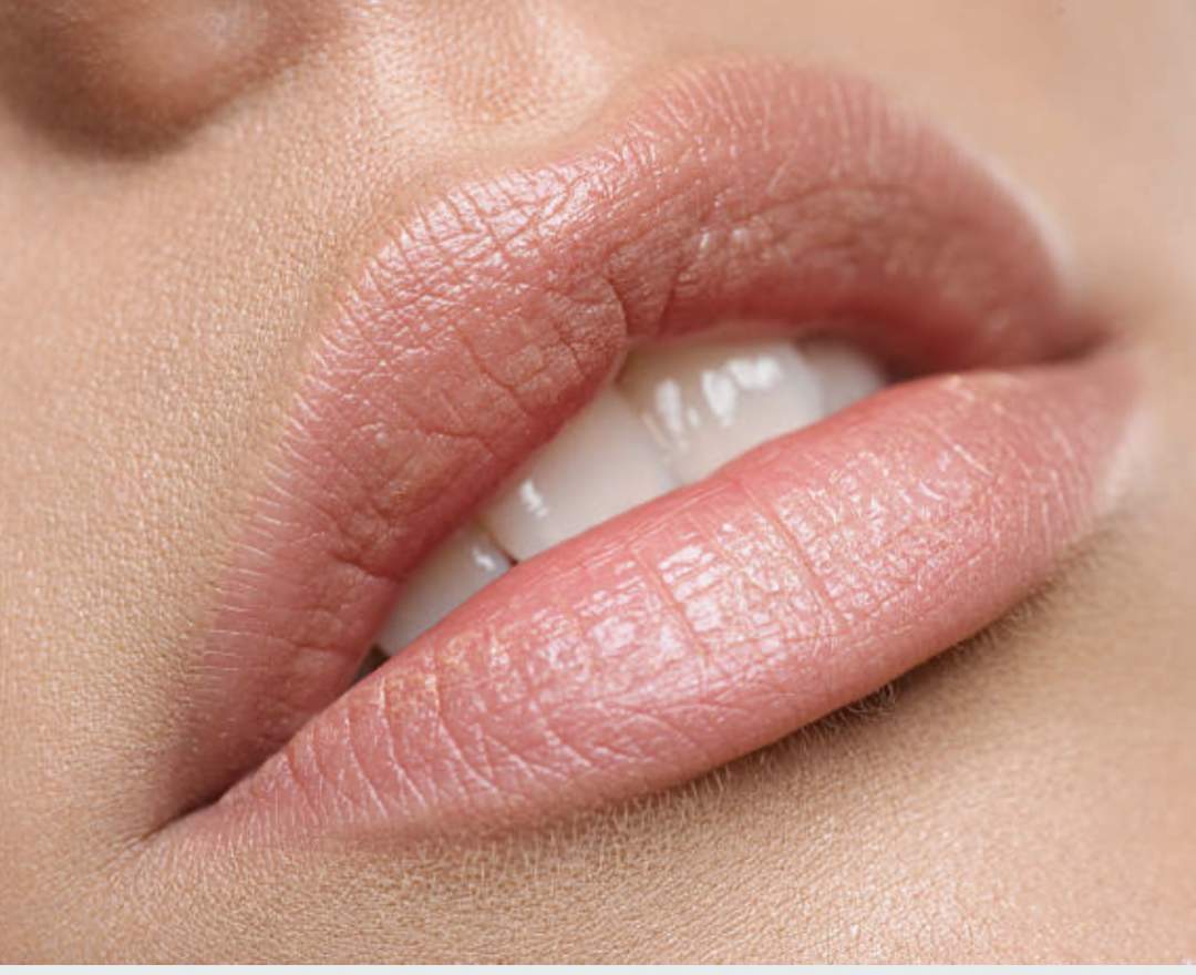  Lippenunterspritzung 1ml