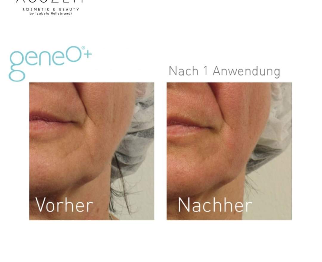 geneo - OxyGeneo - Gesichtsbehandlung mit Sauerstoffpeeling, individueller Maske & Hyaluronsäure PREMIUM PAKET