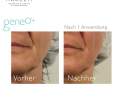 geneo - OxyGeneo - Gesichtsbehandlung mit Sauerstoffpeeling, individueller Maske & Hyaluronsäure PREMIUM PAKET Thumbnail