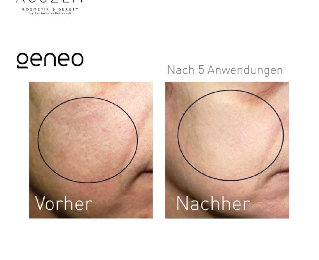 geneo - OxyGeneo - Gesichtsbehandlung mit Sauerstoffpeeling, individueller Maske & Hyaluronsäure PREMIUM PAKET