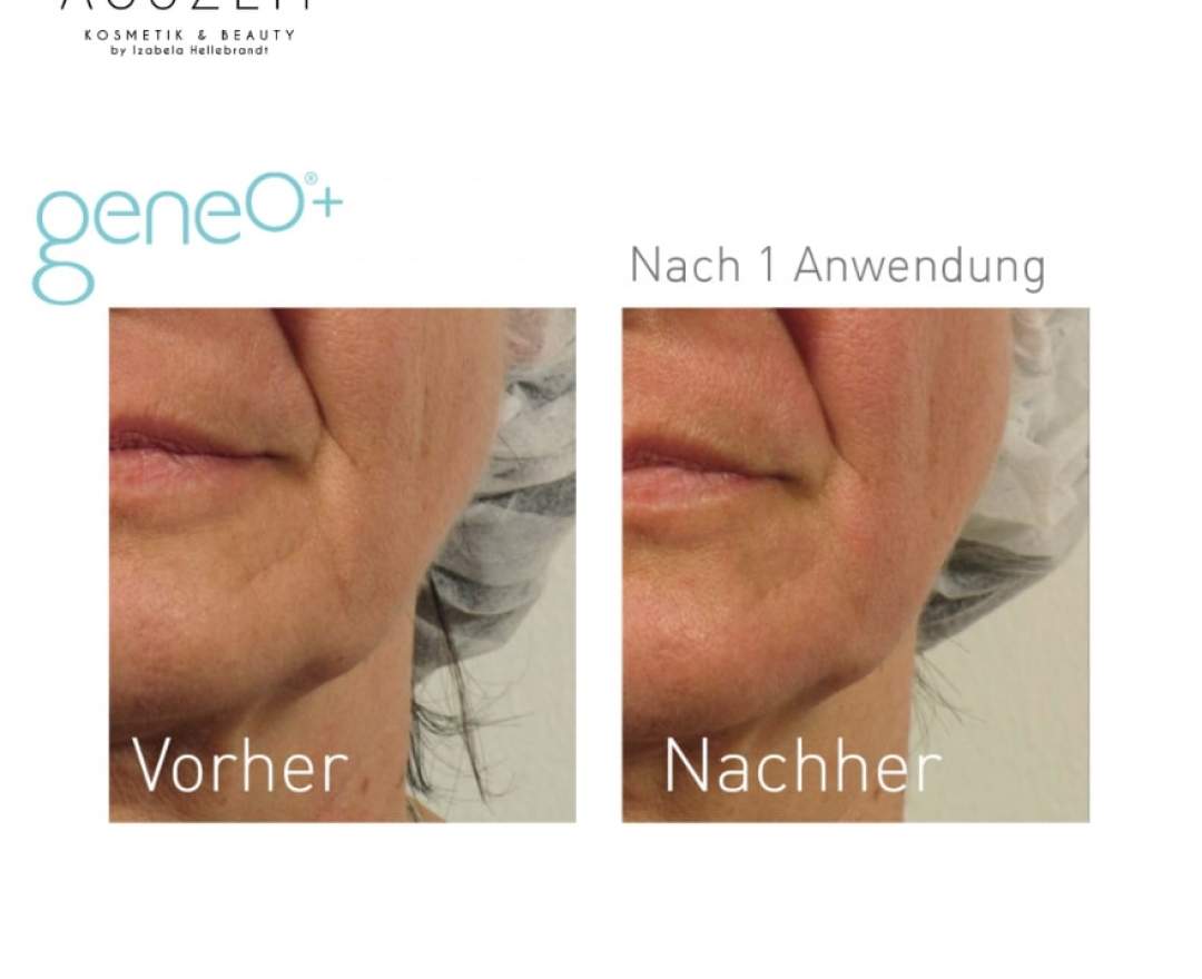 geneo - OxyGeneo - Gesichtsbehandlung mit Sauerstoffpeeling, individueller Maske & Hyaluronsäure STANDART PAKET