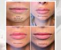 Teoxane - Lippenunterspritzung Thumbnail