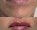 Teoxane - Lippenunterspritzung Thumbnail