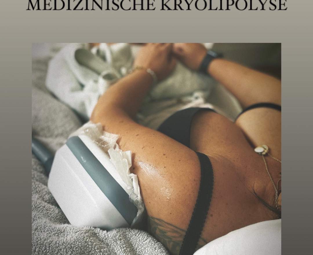 Cocoon Medical - Kryolipolyse