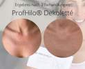 Profhilo® - ProfHilo® Thumbnail
