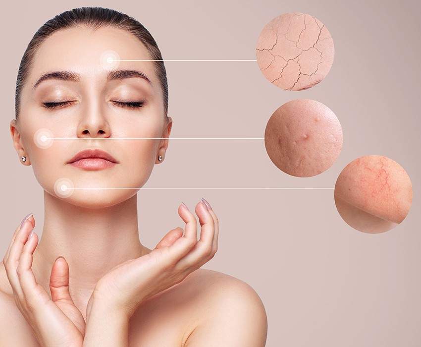 Swiss Derma Clinic Rosazea