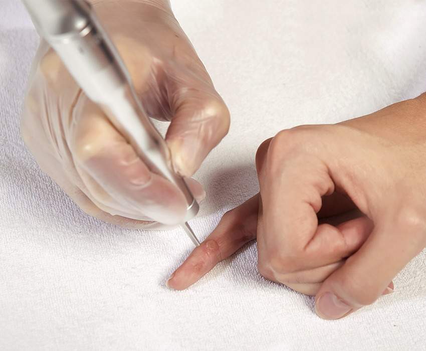 Swiss Derma Clinic Warzen